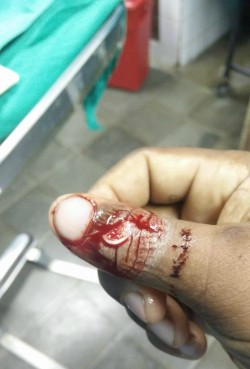 Kharron bloody thumb