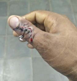Kharron thumb with pins